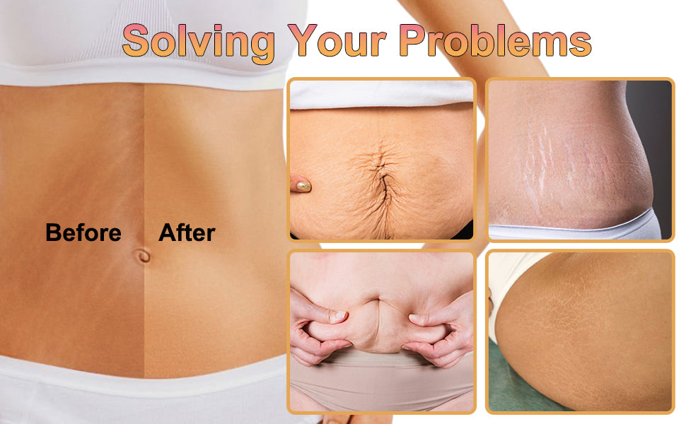 TLOPA® B-FLAT Clinically Proven Belly Firming Cream for Stretch Marks And Loose Skin - With Avocado Extract